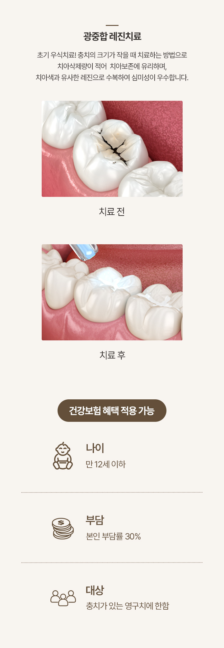 광중합 레진치료