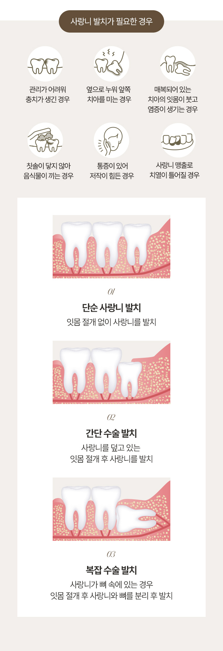 사랑니발치