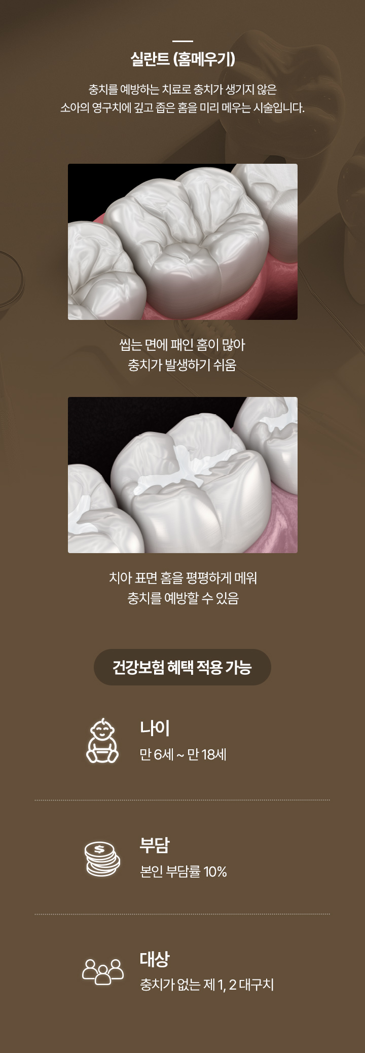 실란트