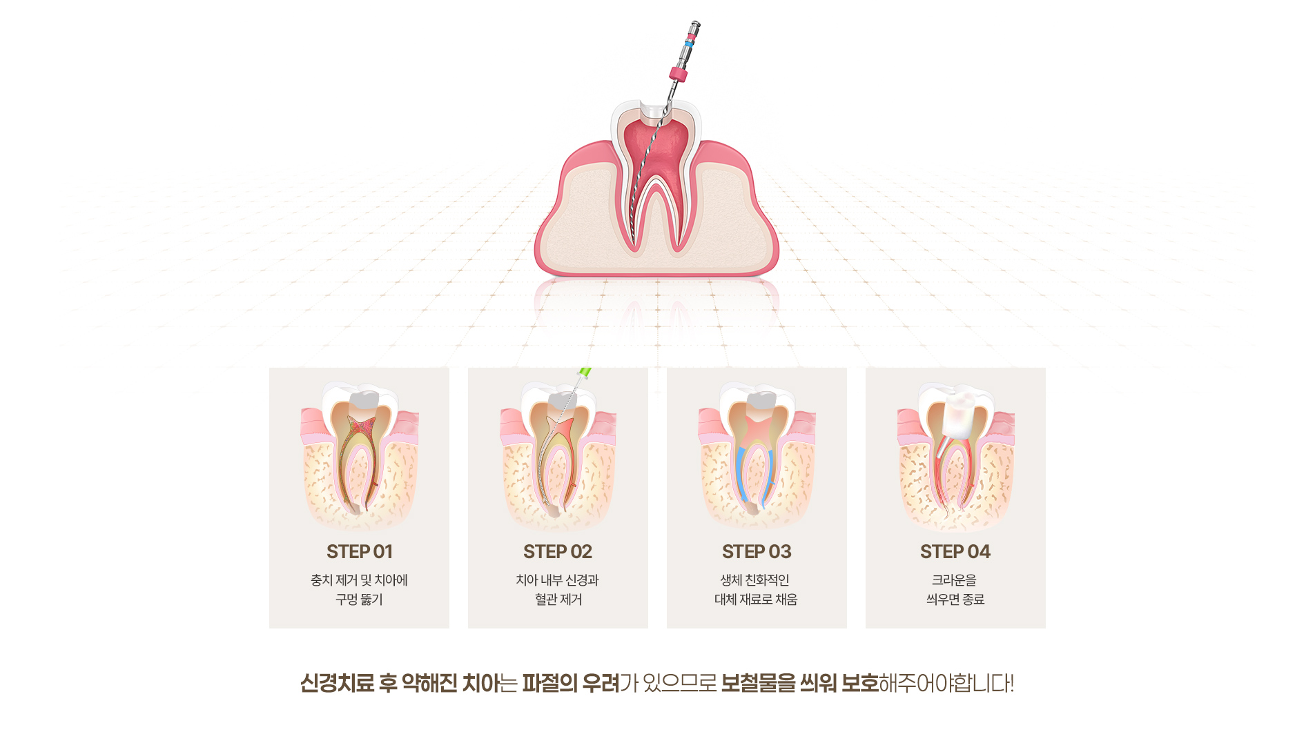 신경치료 과정